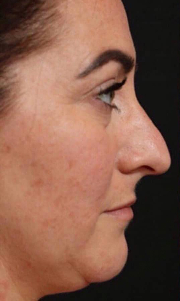 Non Surgical Rhinoplasty Before and After | Dr. Ashlin Alexander